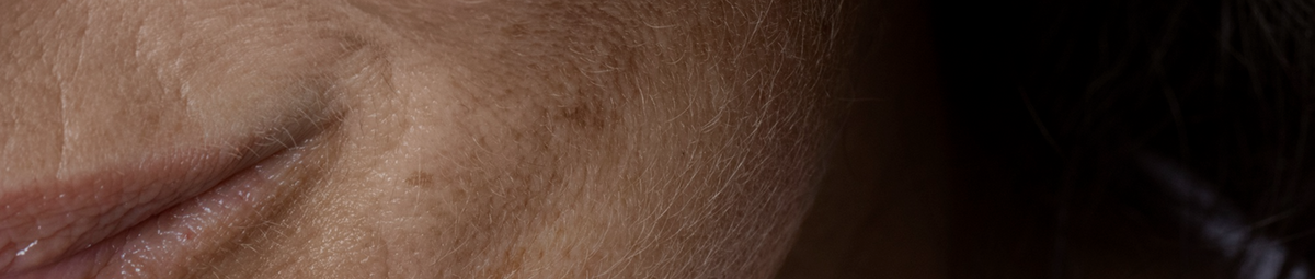 Damaged Skin Barrier